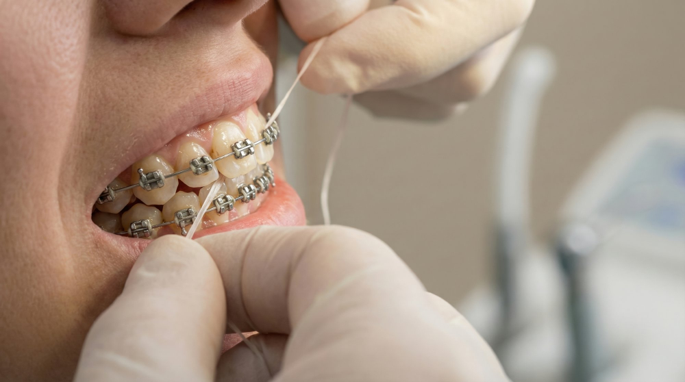 Braces & Orthodontic Appliances2