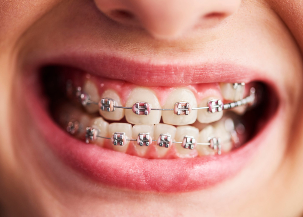 Braces & Orthodontic Appliances3