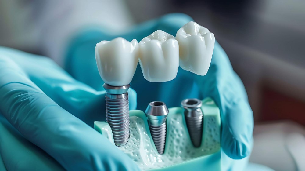 Dental Implants1-100kb