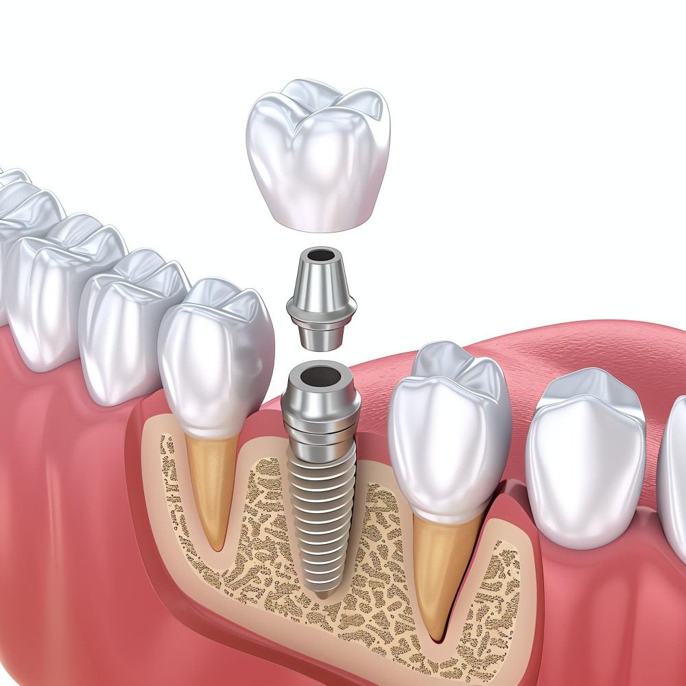 Dental Implants2-100kb