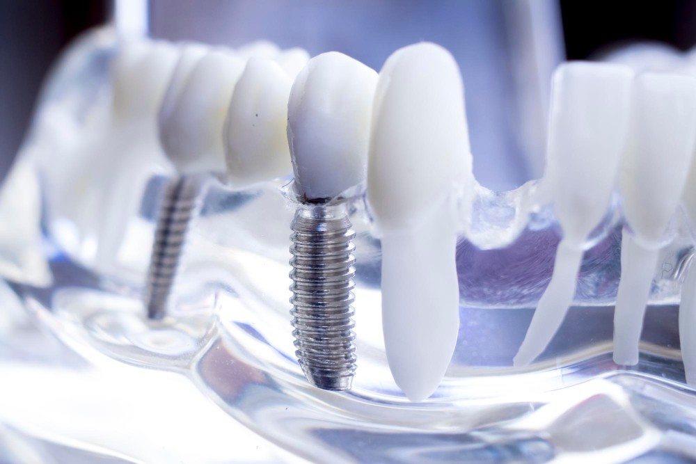 Dental Implants3-100kb