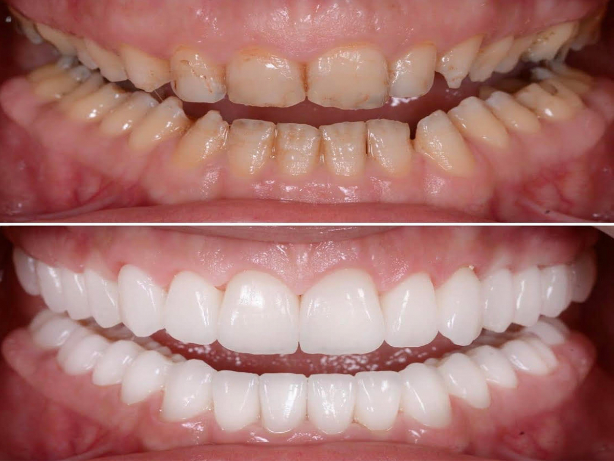 Full-Mouth-Rehablitation1