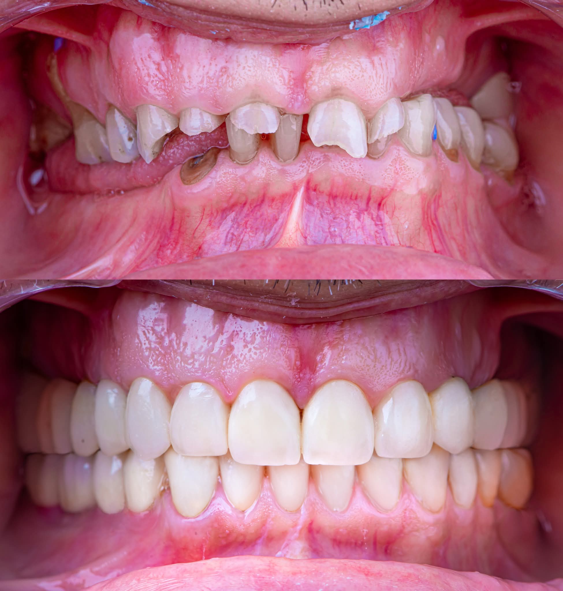 Full-Mouth-Rehablitation2