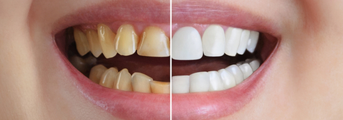 Full-Mouth-Rehablitation3