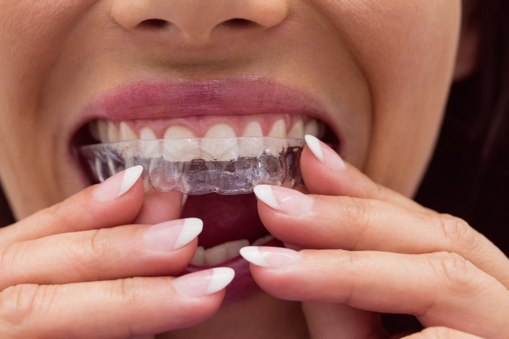 Invisible Aligners1