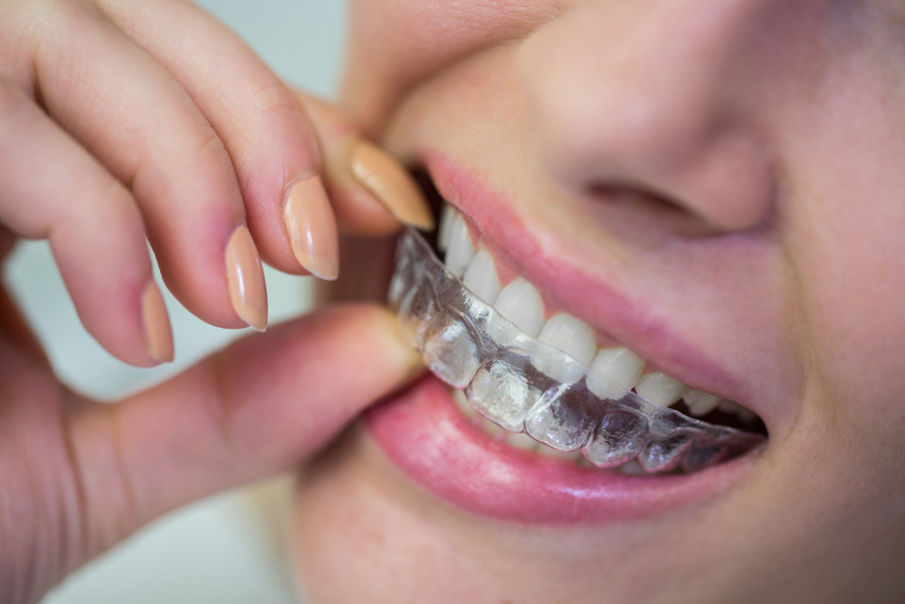Invisible Aligners2