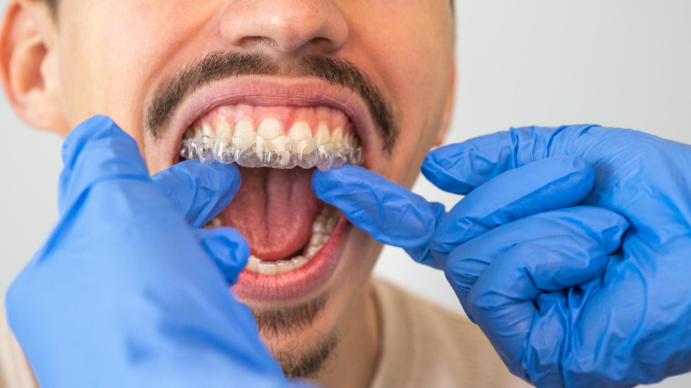 Invisible Aligners3