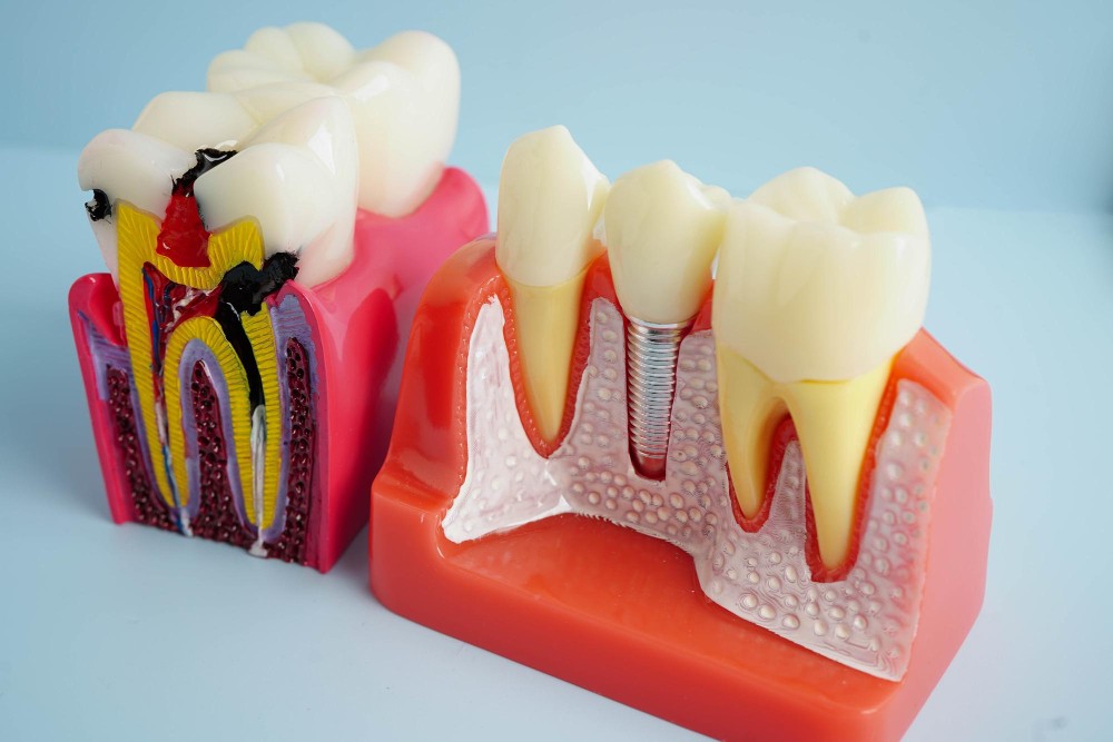 Root Canal Treatment3-100kb