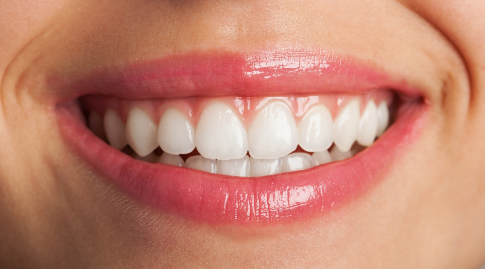 Smile Makeover3