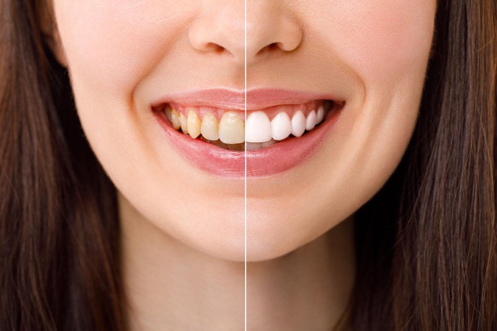 Teeth Whitening2