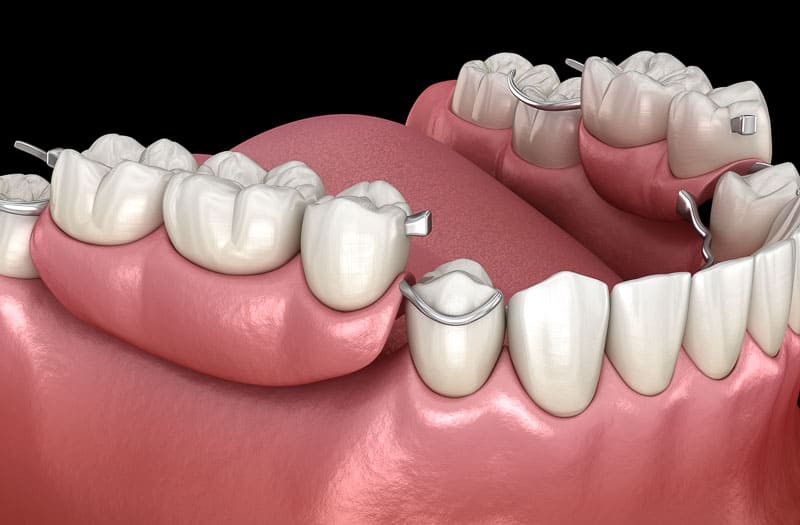partial-dentures-1-100kb