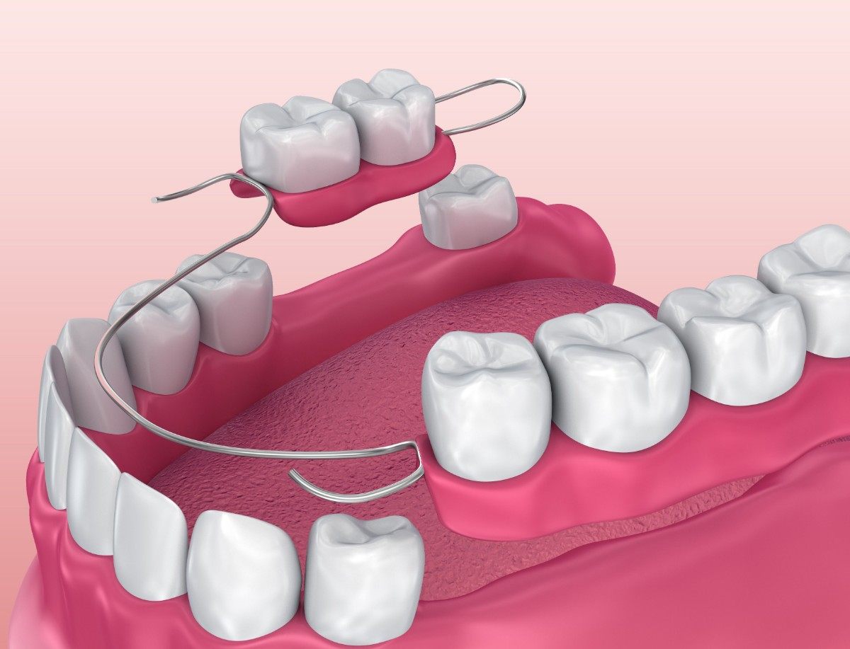 partial-dentures-3-100kb